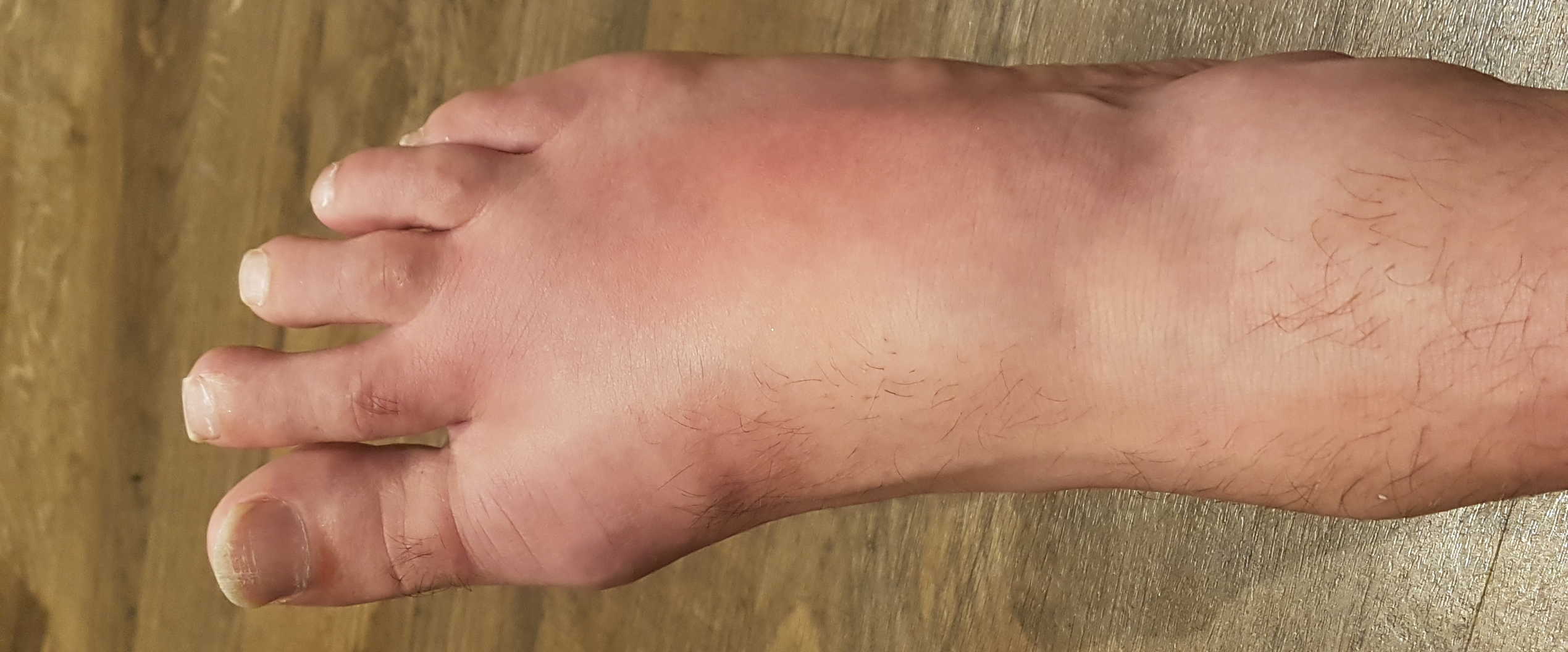 Gouty Foot